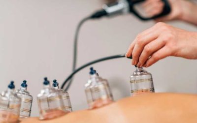 What is cupping therapy?