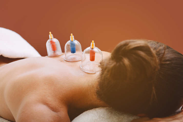 Top 10 Ways Cupping Therapy Can Help You