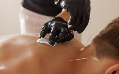 Dry Needling: What it is and how can it help you